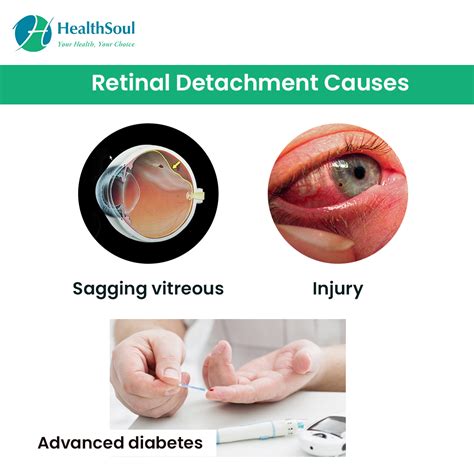 drop tested retina case|Retinal Detachment: Symptoms & Causes .